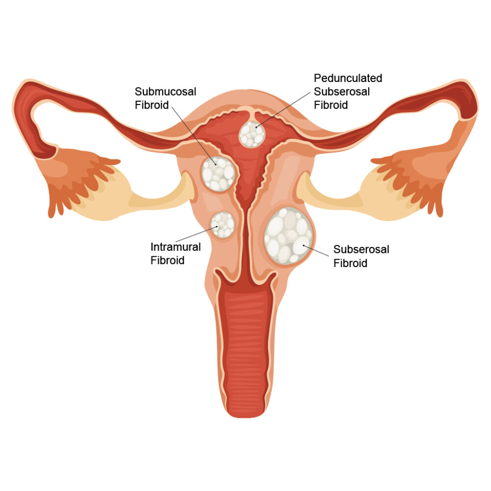 Uterine Fibroids and treatment in San Diego at Precisions Therapy of IHS